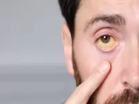 jaundice symptoms in Hindi 